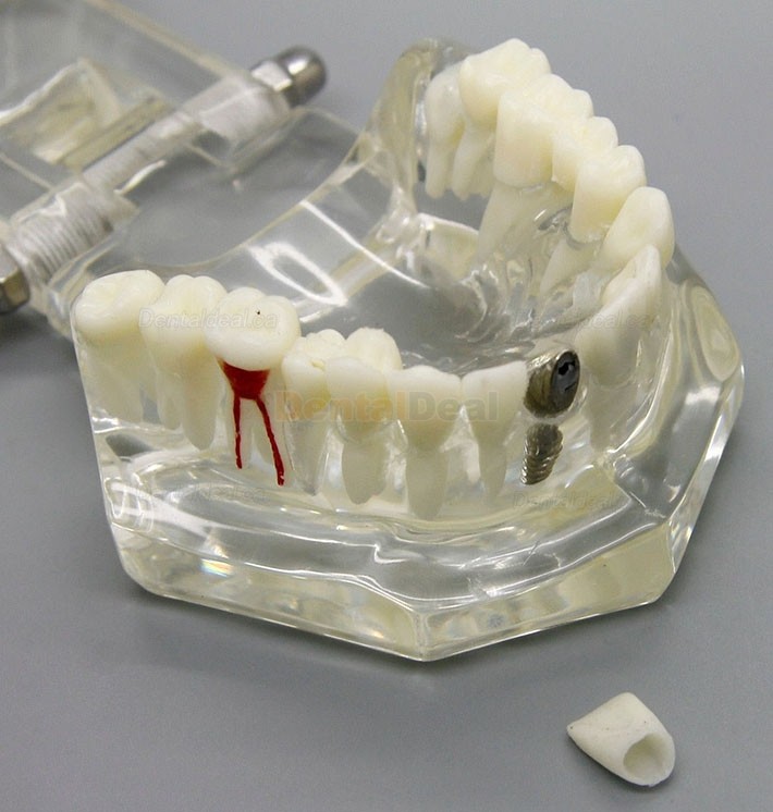 Dental Implant Study Demonstration Teeth Disease Model with Restoration for Students